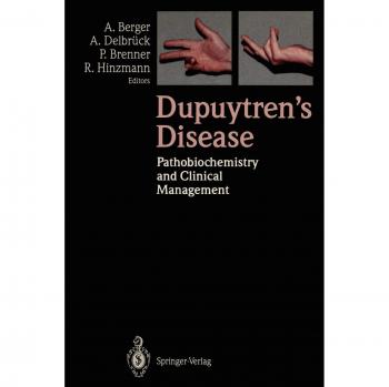 Dupuytren¿s Disease